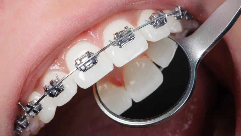 Ortodoncia con brackets metálicos en Málaga