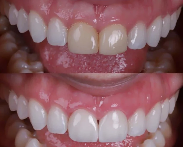 Carillas dentales composite, Carrilero Dental