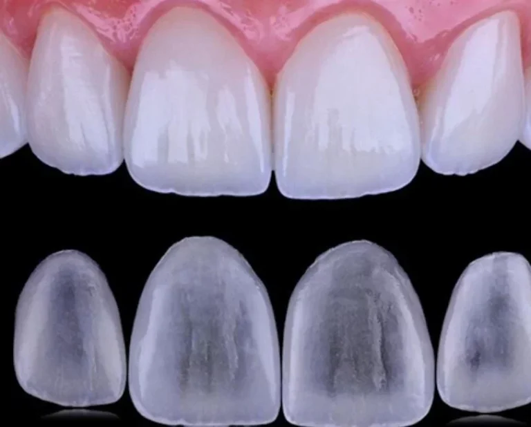 Carillas dentales porcelana, Carrilero Dental