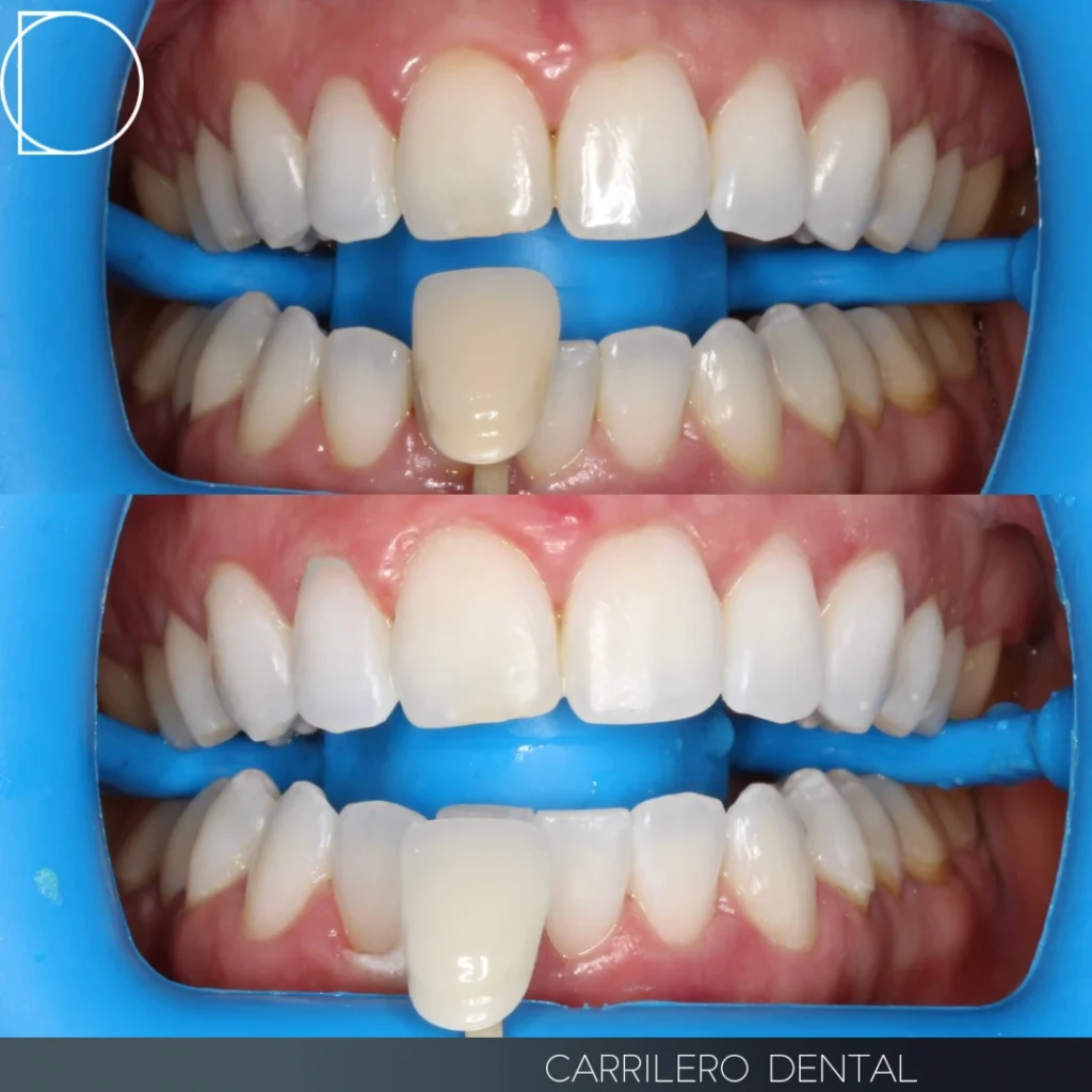 Blanqueamiento dental