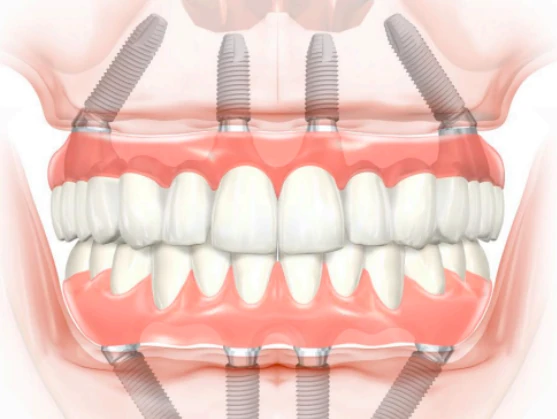 implante dental all on four