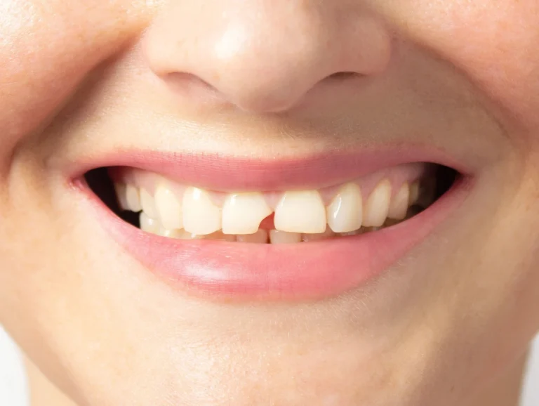 Odontología restauradora en Carrilero Dental